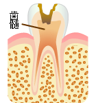 C3：歯の神経（歯髄）の虫歯歯