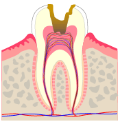 歯髄炎（臼歯の虫歯）