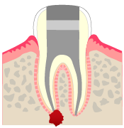 根尖性歯周炎（臼歯）