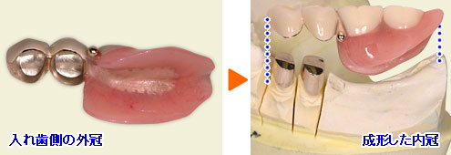 入れ歯側の外冠（左）と成形した内冠（右）