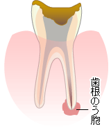 歯根のう胞
