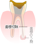 歯根端切除
