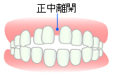 空隙歯列（くうげきしれつ）−すきっ歯