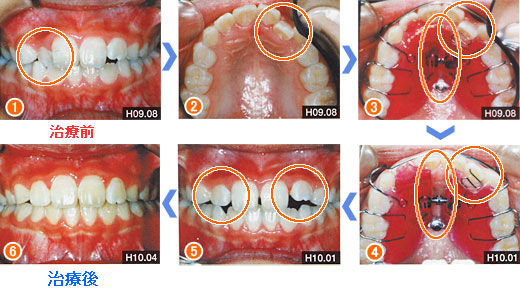 前歯の叢生