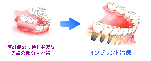 奥歯３本を失った、もしくは部分入れ歯の場合の治療