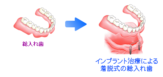 全ての歯を失った場合の治療