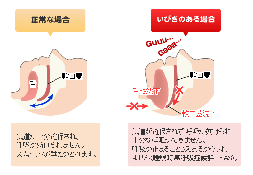 いびきのメカニズム