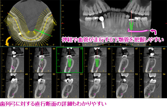 神経や血管が走行する下顎管を把握しやすいから歯科インプラントの治療計画も万全！