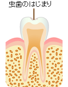 CO：初期虫歯