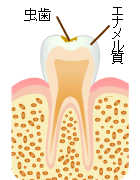 C1：エナメル質の虫歯