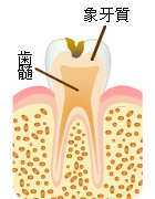 C2：象牙質の虫歯