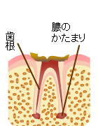 C4：末期の虫歯