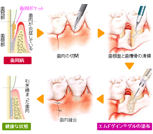 エムドゲインゲルによる歯周組織再生療法