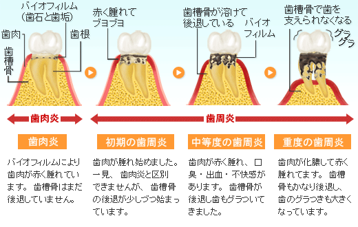 歯周病の進行