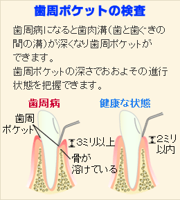 歯周ポケットの検査