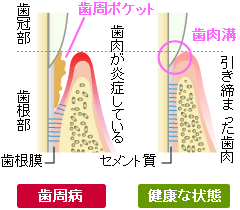 歯肉溝と歯周ポケット