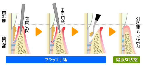 歯周ポケット掻爬(そうは)術