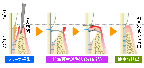 組織再生誘導法（GTR法）