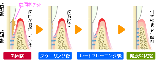 ルートプレーにグ（歯根面クリーニング）