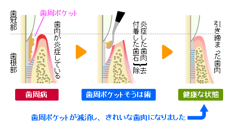 歯周ポケット掻爬(そうは)術