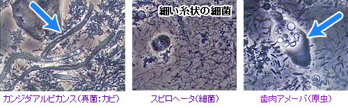 歯周病の原因となる微生物