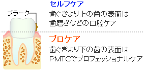 歯のクリーニング（ＰＭＴＣ）−プロフェッショナルクリーニング