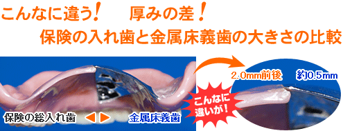 こんなに違う！　厚みの差！保険の入れ歯と金属床義歯の大きさの比較