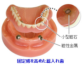 固定感を高めた総入れ歯