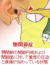 顎関節症