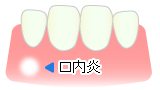 口内炎