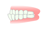 反対咬合（下顎前突）