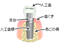 インプラント治療