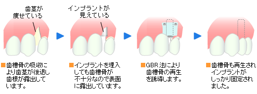 インプラント手術と同時に骨の再生をする場合