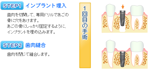 インプラント治療の流れ