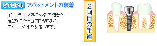 インプラント治療の流れ