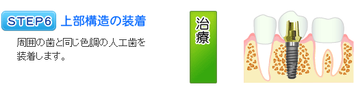 インプラント治療の流れ