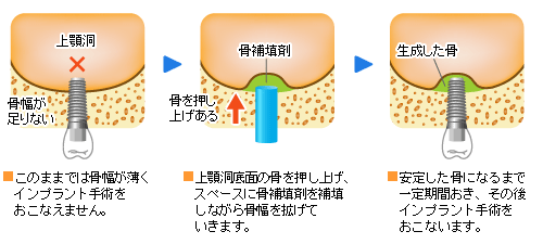 ソケットリフト法