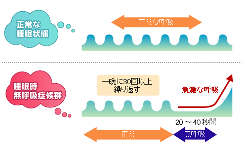 睡眠時無呼吸症候群（ＳＡＳ）は睡眠障害という病気です！